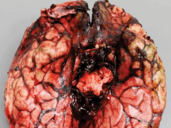 Image: Gross and histopathologic features of acute fatal Exserohilum meningitis. Hemorrhage around the base of the brain (Photo courtesy of the American Journal of Pathology).